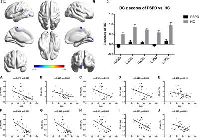 Altered Brain Functional Hubs and Connectivity Underlie Persistent Somatoform Pain Disorder